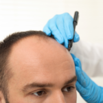 CURSO DE MICROPIGMENTACION CAPILAR
